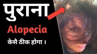 How to Treat old Alopecia || Universalis, Totalis || Ayurvedic Panchkarma,cleansing  for Alopecia